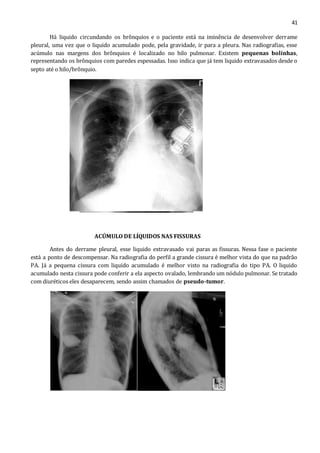 41 
Há liquido circundando os brônquios e o paciente está na iminência de desenvolver derrame 
pleural, uma vez que o liquido acumulado pode, pela gravidade, ir para a pleura. Nas radiografias, esse 
acúmulo nas margens dos brônquios é localizado no hilo pulmonar. Existem pequenas bolinhas, 
representando os brônquios com paredes espessadas. Isso indica que já tem liquido extravasados desde o 
septo até o hilo/brônquio. 
ACÚMULO DE LÍQUIDOS NAS FISSURAS 
Antes do derrame pleural, esse liquido extravasado vai paras as fissuras. Nessa fase o paciente 
está a ponto de descompensar. Na radiografia do perfil a grande cissura é melhor vista do que na padrão 
PA. Já a pequena cissura com liquido acumulado é melhor visto na radiografia do tipo PA. O liquido 
acumulado nesta cissura pode conferir a ela aspecto ovalado, lembrando um nódulo pulmonar. Se tratado 
com diuréticos eles desaparecem, sendo assim chamados de pseudo-tumor. 
 