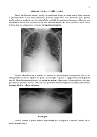 42 
DERRAME PLEURAL/EFUSÃO PLEURAL 
Depois das fissuras/cissuras é que há o acumulo deste liquido no espaço pleural. Neste momento 
o paciente começa a ficar muito sintomático. Para que chegue nesta fase é necessário que a pressão 
capilar pulmonar esteja elevada. Na radiografia há opacidade homogênea nas bases que vai fazendo uma 
curva lateral. Na ICC o derrame é bilateral e mais acentuado à direita. Há perda das linhas A e B de Kerley. 
O único sinal que ainda persiste nesta fase é a hipertensão venosa. 
Por fim, o liquido invade os alvéolos e o paciente fica, então, dispnéico aos pequenos esforços. Na 
radiografia há opacidades algodonosas, que é a consolidação, ocupando os espaços aéreos com disposição 
central. Há também a famosa imagem em asa de borboleta e há um maior comprometimento das bases 
pela ação da gravidade. Quando está nesta fase, geralmente há derrame pleural. Nessa fase, então, temos 
derrame pleural e edema pulmonar. 
Resolução: 
Quando tratado, o quadro melhora rapidamente. Nas radiografias a melhora costuma ser da 
periferia para o centro. 
 