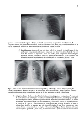 5 
Quando o coração se desloca para a direita, sua borda esquerda vai se aproximar da linha média. A 
traqueia também está bem deslocada. Então, é um sinal de atelectasia. Outra coisa que chama a atenção, é 
que se trata de um paciente do sexo feminino com apenas uma mama (direita). 
c) Hemidiafragma também é uma estrutura móvel do tórax. O hemidiafragma direito 
está quase sempre mais alto que o esquerdo, isso é normal (é fisiológico). Mas em 
10% das pessoas, o esquerdo é mais alto. Então, nem sempre um hemidiafragma 
esquerdo elevado é anormal. Agora, na presença da atelectasia, principalmente nos 
lobos inferiores, o hemidiafragma do lado afetado vai estar deslocado para cima. 
Aqui a gente vê uma atelectasia do lobo superior esquerdo (é anterior). A fissura obliqua (maior) foi 
deslocada para frente por causa da perda de volume que puxou essa fissura. E observa-se uma discreta 
elevação do hemidiafragma esquerdo em relação ao direito, por causa da perda volumétrica. 
4. A hiperinsuflação dos lobos não afetados ipsilaterais ou do pulmão contralateral. Foi acabado 
de falar, se você tem uma região onde houve uma redução do volume, a outra (adjacente) vai 
tentar compensar. Então, numa área pulmonar com atelectasia ou numa atelectasia de todo o 
pulmão vai ocorrer desvio das estruturas móveis e o pulmão normal vai ficar hiperinsuflado 
na tentativa de repor o volume dentro do tórax. Então, vai ter uma alteração no aspecto 
radiográfico também no pulmão que não tem atelectasia, ele vai ficar mais aerado, mais 
escuro. Isso é bem evidenciado na região retroesternal da figura abaixo. É como se tivesse 
uma radiografia queimada (muito raio), mas na verdade é o pulmão que está aerado demais 
 