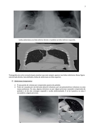 7 
Linha atelectásica no lobo inferior direito e também no lobo inferior esquerdo. 
Tomografia em corte coronal só para mostrar que nem sempre aparece nos lobos inferiores. Nessa figura 
está do lado direito, bem definida a linha de atelectasia no lobo superior. 
2) Atelectasia Compressiva: 
 É uma perda de volume por compressão passiva do pulmão. 
 Pode ser causada por um derrame pleural volumoso, por um pneumotórax volumoso ou uma 
massa pulmonar. Ou seja, alguma estrutura ou por algum processo causando compressão do 
pulmão e aí ele não consegue expandir e acaba atelectasiando. E aí já é passiva, ou seja, é 
secundário a algum processo. 
 