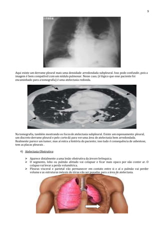 9 
Aqui existe um derrame pleural mais uma densidade arredondada subpleural. Isso pode confundir, pois a 
imagem é bem compatível com um nódulo pulmonar. Nesse caso, (é lógico que esse paciente foi 
encaminhado para a tomografia) é uma atelectasia redonda. 
Na tomografia, também mostrando os focos de atelectasia subpleural. Existe um espessamento pleural, 
um discreto derrame pleural e pelo corte dá para ver uma área de atelectasia bem arredondada. 
Realmente parece um tumor, mas aí entra a história do paciente; isso tudo é consequência de asbestose, 
tem as placas pleurais . 
4) Atelectasia Obstrutiva: 
 Aparece distalmente a uma lesão obstrutiva da árvore brônquica. 
 O segmento, lobo ou pulmão afetado vai colapsar e ficar mais opaco por não conter ar. O 
colapso vai levar a perda volumétrica. 
 Pleuras visceral e parietal vão permanecer em contato entre si e aí o pulmão vai perder 
volume e as estruturas móveis do tórax vão ser puxadas para a área de atelectasia. 
 