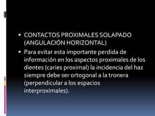  CONTACTOS PROXIMALES SOLAPADO
(ANGULACIÓN HORIZONTAL)
 Para evitar esta importante perdida de
información en los aspectos proximales de los
dientes (caries proximal) la incidencia del haz
siempre debe ser ortogonal a la tronera
(perpendicular a los espacios
interproximales).
 