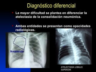 Radiologia 1 Atelectasia | PPT
