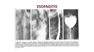 Radiologia de esofago y estomago | PPTX