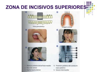 ZONA DE INCISIVOS SUPERIORES 