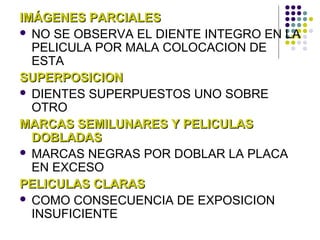 IMÁGENES PARCIALES NO SE OBSERVA EL DIENTE INTEGRO EN LA PELICULA POR MALA COLOCACION DE ESTA SUPERPOSICION DIENTES SUPERPUESTOS UNO SOBRE OTRO MARCAS SEMILUNARES Y PELICULAS DOBLADAS MARCAS NEGRAS POR DOBLAR LA PLACA EN EXCESO  PELICULAS CLARAS COMO CONSECUENCIA DE EXPOSICION INSUFICIENTE 
