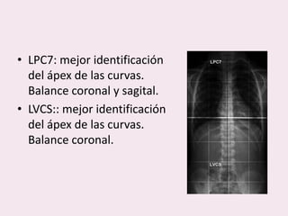 Radiología de la escoliosis | PPTX