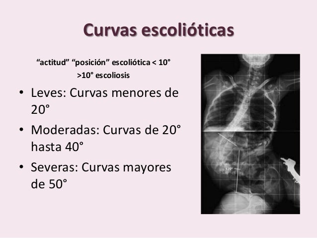 Radiología de la escoliosis