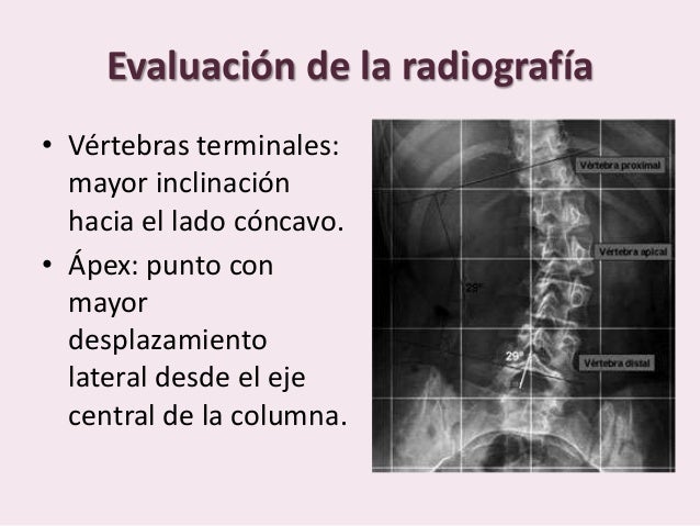 Radiología de la escoliosis