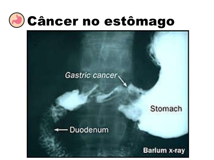 Seriografia De Esôfago Estômago E Duodeno Codigo