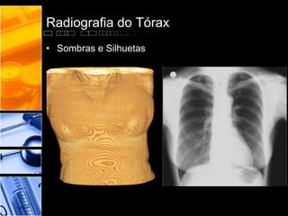 Radiografia do Tórax 
• Sombras e Silhuetas 
 