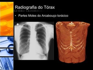 Radiografia do Tórax 
• Partes Moles do Arcabouço torácico 
 