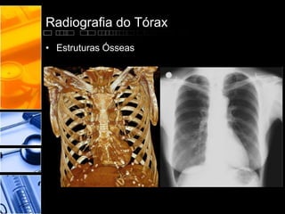 Radiografia do Tórax 
• Estruturas Ósseas 
 