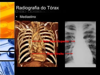 Radiografia do Tórax 
• Mediastino 
 