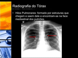 Radiografia do Tórax 
• Hilos Pulmonares: formado por estruturas que 
chegam e saem dele e encontram-se na face 
mediastinal dos pulmões. 
 