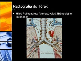 Radiografia do Tórax 
• Hilos Pulmonares: Artérias, veias, Brônquios e 
linfonodos 
 
