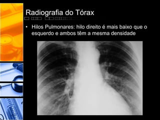 Radiografia do Tórax 
• Hilos Pulmonares: hilo direito é mais baixo que o 
esquerdo e ambos têm a mesma densidade 
 
