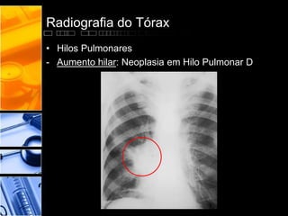 Radiografia do Tórax 
• Hilos Pulmonares 
- Aumento hilar: Neoplasia em Hilo Pulmonar D 
 