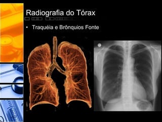 Radiografia do Tórax 
• Traquéia e Brônquios Fonte 
 