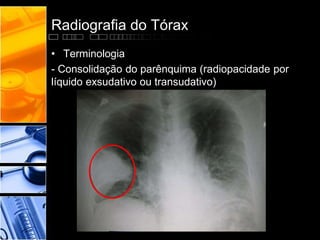 Radiografia do Tórax 
• Terminologia 
- Consolidação do parênquima (radiopacidade por 
líquido exsudativo ou transudativo) 
 