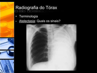 Radiografia do Tórax 
• Terminologia 
- Atelectasia: Quais os sinais? 
 