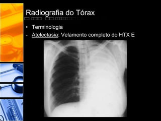 Radiografia do Tórax 
• Terminologia 
- Atelectasia: Velamento completo do HTX E 
 