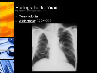 Radiografia do Tórax 
• Terminologia 
- Atelectasia: ???????? 
 