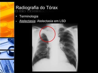 Radiografia do Tórax 
• Terminologia 
- Atelectasia: Atelectasia em LSD 
 