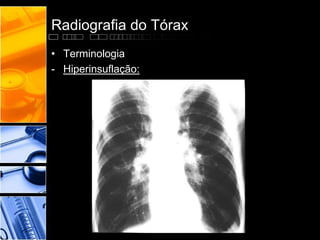Radiografia do Tórax 
• Terminologia 
- Hiperinsuflação: 
 
