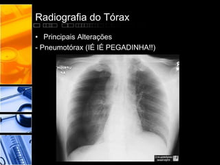 Radiografia do Tórax 
• Principais Alterações 
- Pneumotórax (IÉ IÉ PEGADINHA!!) 
 