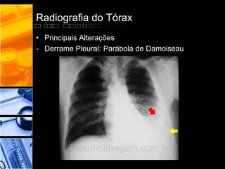 Radiografia do Tórax 
• Principais Alterações 
- Derrame Pleural: Parábola de Damoiseau 
 