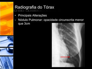 Radiografia do Tórax 
• Principais Alterações 
- Nódulo Pulmonar: opacidade circunscrita menor 
que 3cm 
 
