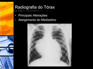 Radiografia do Tórax 
• Principais Alterações 
- Alargamento do Mediastino 
 