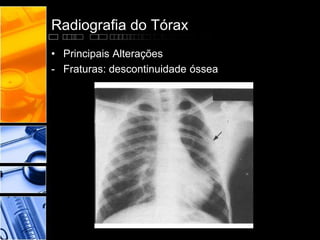 Radiografia do Tórax 
• Principais Alterações 
- Fraturas: descontinuidade óssea 
 