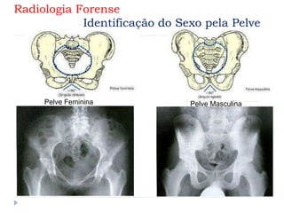 Pelve Feminina Pelve Masculina
Radiologia Forense
Identificação do Sexo pela Pelve
 