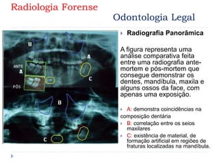 Radiografia Panorâmica
A figura representa uma
análise comparativa feita
entre uma radiografia ante-
mortem e pós-mortem que
consegue demonstrar os
dentes, mandíbula, maxila e
alguns ossos da face, com
apenas uma exposição.
 A: demonstra coincidências na
composição dentária
 B: correlação entre os seios
maxilares
 C: existência de material, de
formação artificial em regiões de
fraturas localizadas na mandíbula.
Radiologia Forense
Odontologia Legal
 