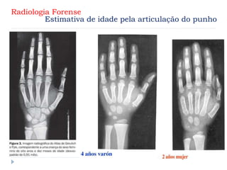 Radiologia Forense
Estimativa de idade pela articulação do punho
 