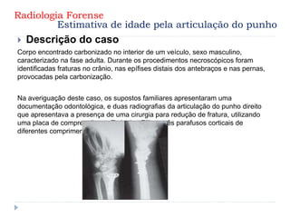  Descrição do caso
Corpo encontrado carbonizado no interior de um veículo, sexo masculino,
caracterizado na fase adulta. Durante os procedimentos necroscópicos foram
identificadas fraturas no crânio, nas epífises distais dos antebraços e nas pernas,
provocadas pela carbonização.
Na averiguação deste caso, os supostos familiares apresentaram uma
documentação odontológica, e duas radiografias da articulação do punho direito
que apresentava a presença de uma cirurgia para redução de fratura, utilizando
uma placa de compressão em T, do tipo Ellis, e três parafusos corticais de
diferentes comprimentos.
Radiologia Forense
Estimativa de idade pela articulação do punho
 