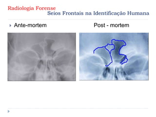  Ante-mortem Post - mortem
Radiologia Forense
Seios Frontais na Identificação Humana
 