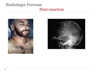 Radiologia Forense
Post-mortem
 