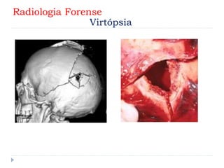 Radiologia Forense
Virtópsia
 