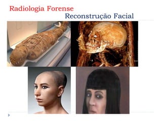 Radiologia Forense
Reconstrução Facial
 
