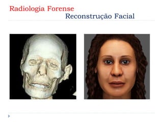 Radiologia Forense
Reconstrução Facial
 