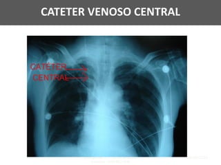 16/06/2020
CT de Medicina de Urgência e
Emergência CT de Medicina
Intensiva - CREMEC/CFM
89
CATETER VENOSO CENTRAL
 