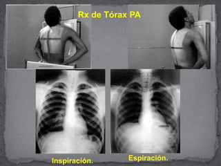 Rx de Tórax PA
Inspiración. Espiración.
 