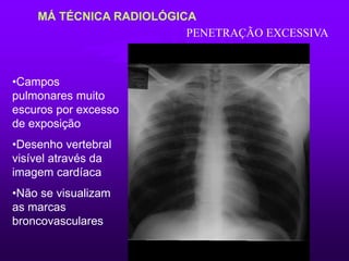 MÁ TÉCNICA RADIOLÓGICA
•Campos
pulmonares muito
escuros por excesso
de exposição
•Desenho vertebral
visível através da
imagem cardíaca
•Não se visualizam
as marcas
broncovasculares
PENETRAÇÃO EXCESSIVA
 