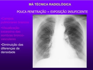 MÁ TÉCNICA RADIOLÓGICA
•Campos
pulmonares brancos
•Visualização
excessiva das
sombras bronco-
vasculares
•Diminuição das
diferenças de
densidade
POUCA PENETRAÇÃO = EXPOSIÇÃO INSUFICIENTE
 