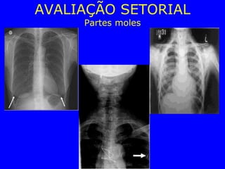 AVALIAÇÃO SETORIAL
Partes moles
 