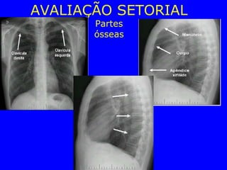 AVALIAÇÃO SETORIAL
Partes
ósseas
 