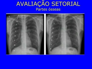 AVALIAÇÃO SETORIAL
Partes ósseas
 